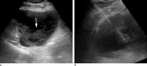 biopsy of ovarian cyst|Iba pa.